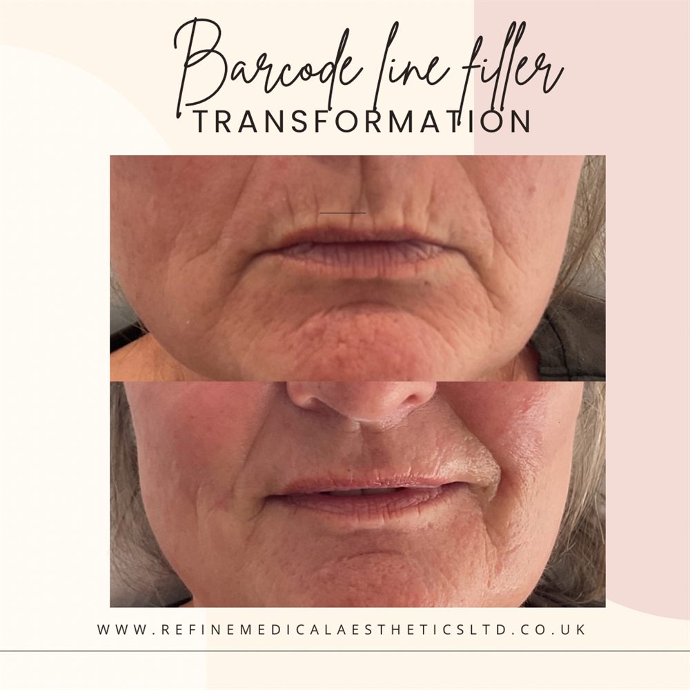 Barcode lip line softening before and after result
