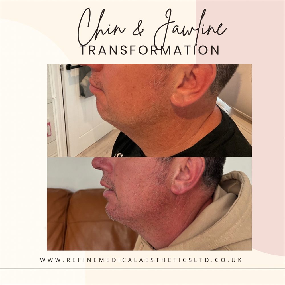 Chin and jawline definition before and after result on a male client