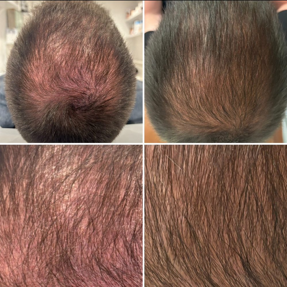 Hair mesotherapy results showing scalp regrowth