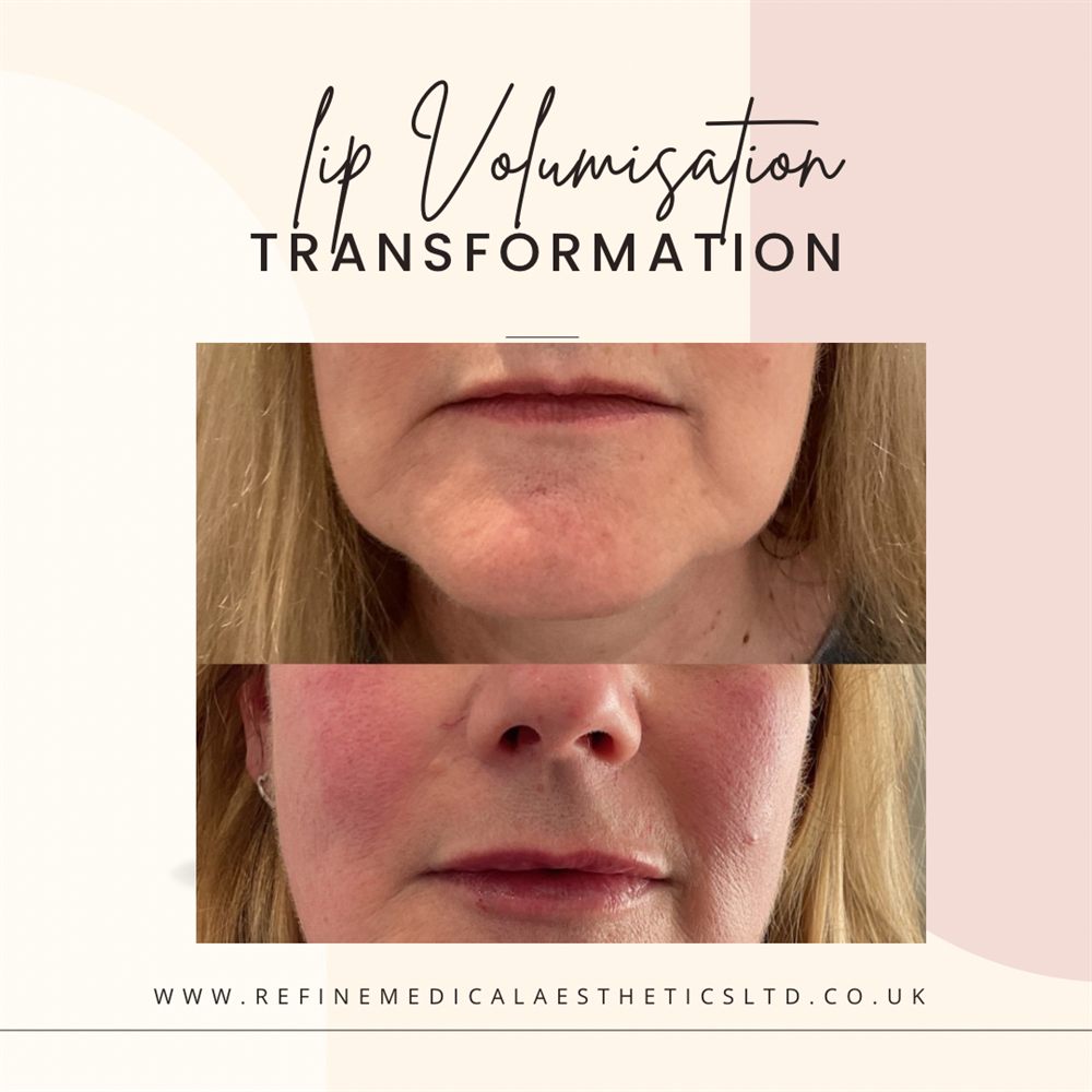 Lip volumisation before and after result