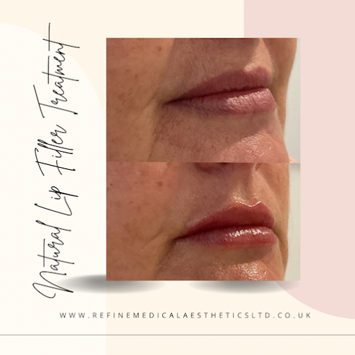 Natural lip filler treatment before and after, side profile