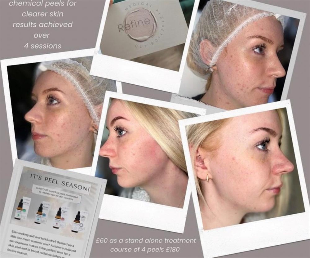 Chemical peel results across a course of four sessions